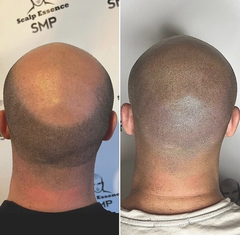 Scalp Micropigmentation London