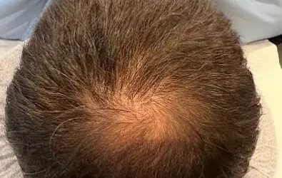 Scalp Micropigmentation Leicester: Natural Hairlines, Real Confidence