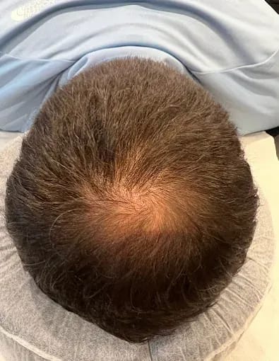 Scalp Micropigmentation Leicester: Natural Hairlines, Real Confidence